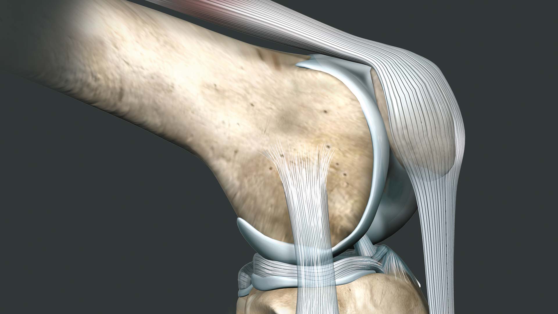 Die Quadrizepssehne hält das obere Ende der Patella und das Kniescheibenband (Patellarsehne) . 